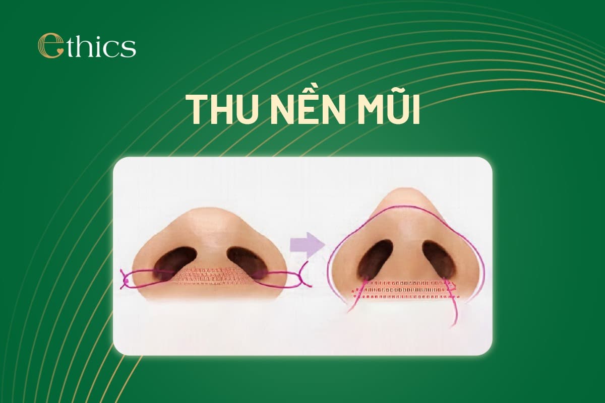 ການປັບຮູບດັງ