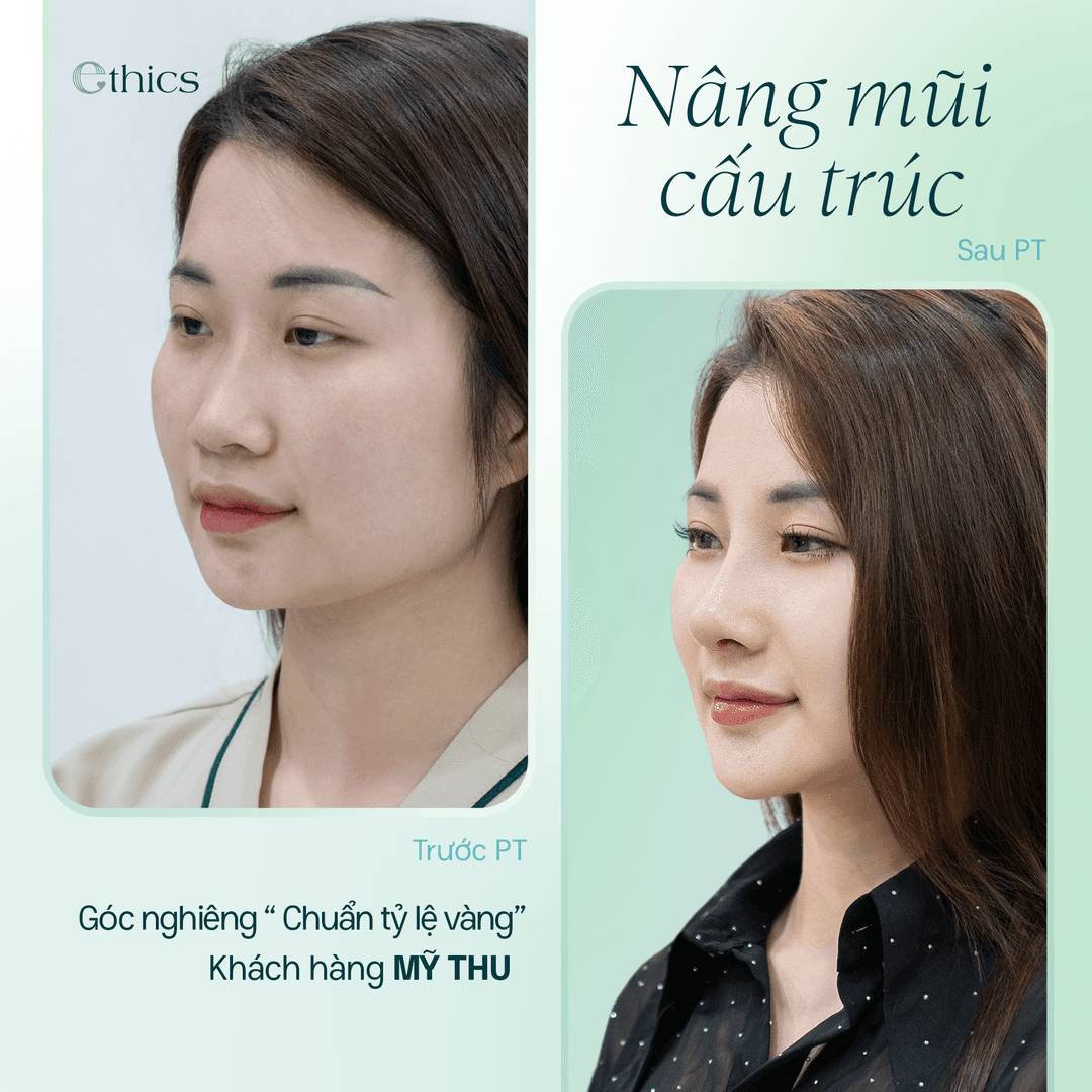 ການປຽບທຽບຮູບພາບຂອງຜູ້ຍິງ ກ່ອນ ແລະ ຫຼັງ ການປັບປຸງຮູບຮ່າງຂອງຈົມູກ