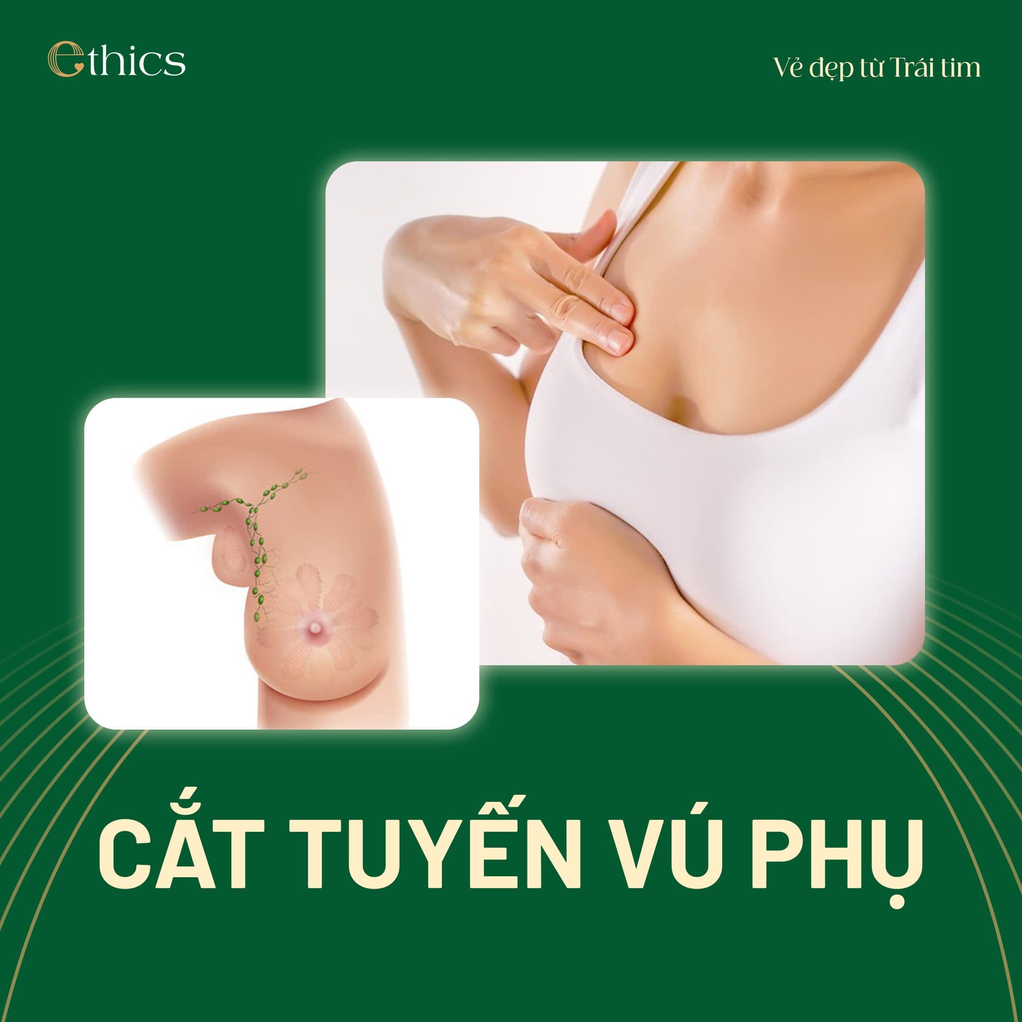 ຕັດເສັ້ນເລືອດແຂ້ວງາມ