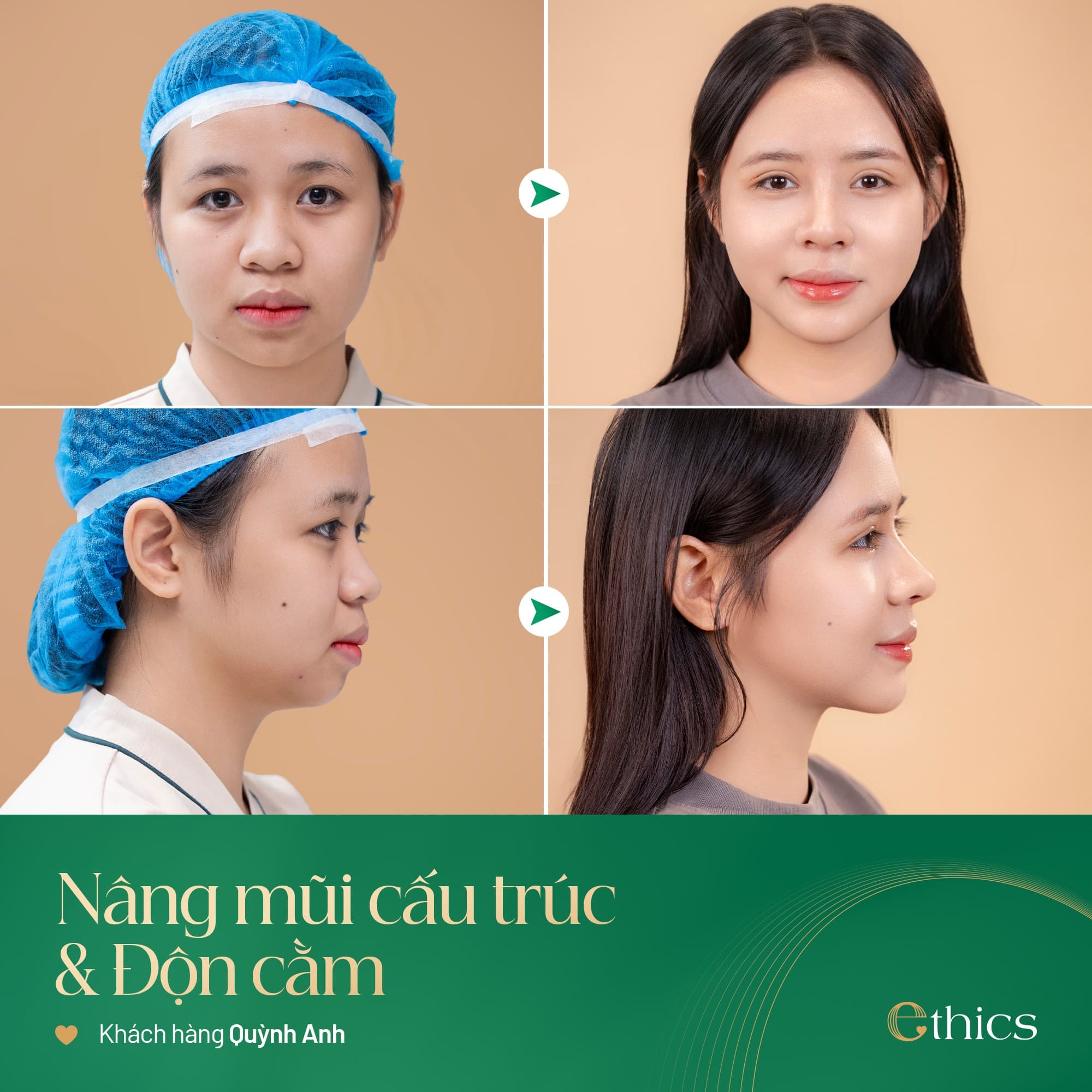 ການປັບປຸງຮູບຮ່າງຂອງຄໍ (ຄໍາວ່າ "Độn cằm" ຫມາຍເຖິງການປັບປຸງຮູບຮ່າງຂອງຄໍ ໃຫ້ໂດ່ງກວ່າ) ໂດຍໃຊ້ຜະລິດຕະພັນ Softxil ຂອງບໍລິສັດ Ethics