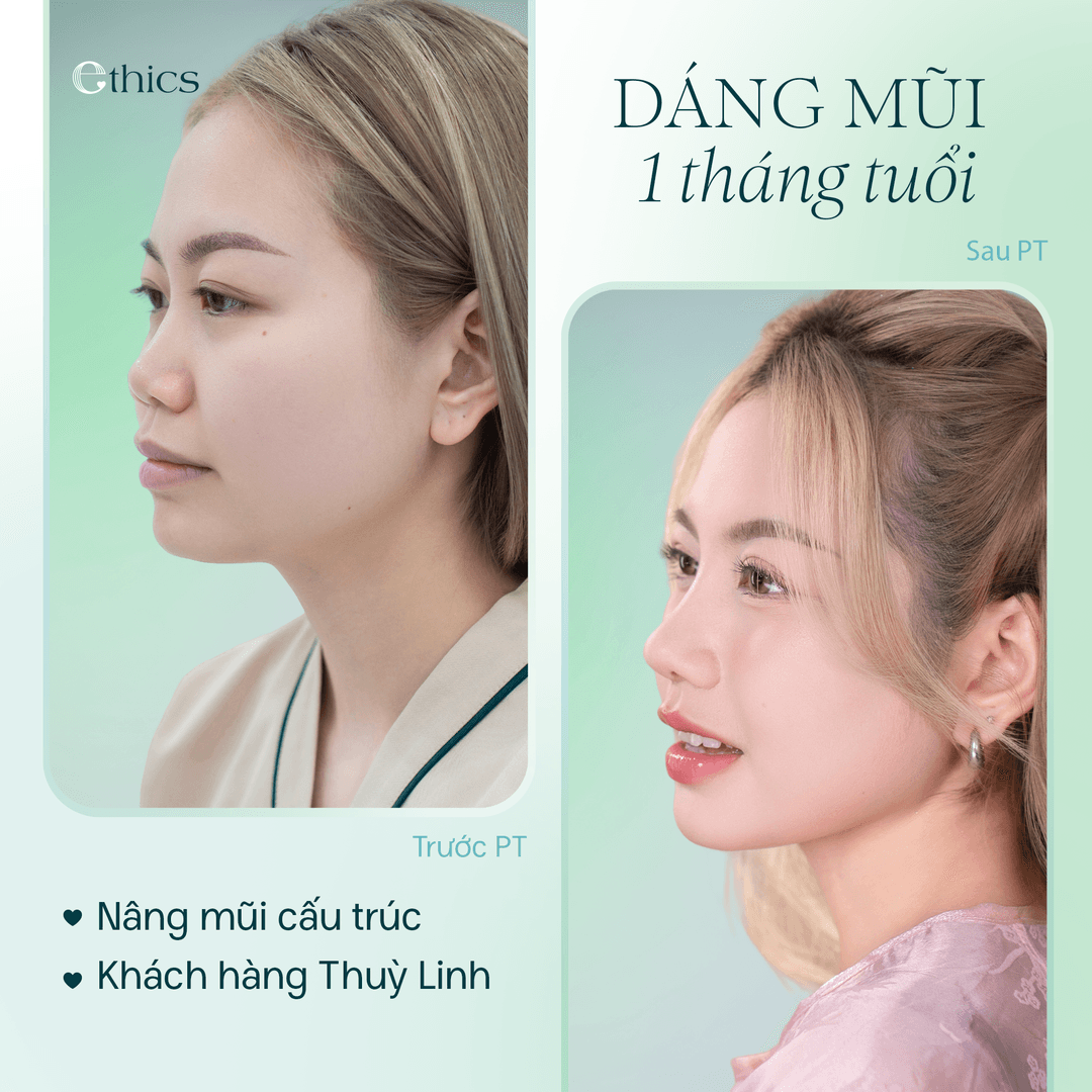 ພາບທຽບທຽບກ່ອນ ແລະ ຫຼັງການປັບປຸງຮູບຮ່າງຂອງຈົມູກສໍາລັບລູກຄ້າ